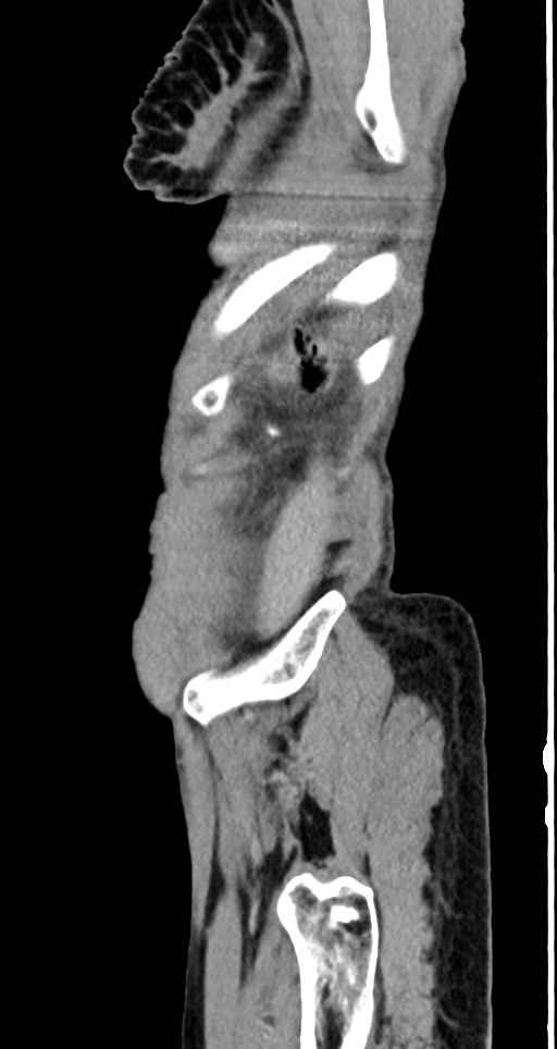 Acute small bowel (ileal) volvulus (Radiopaedia 71740-82139 Sagittal C+ portal venous phase 27).jpg