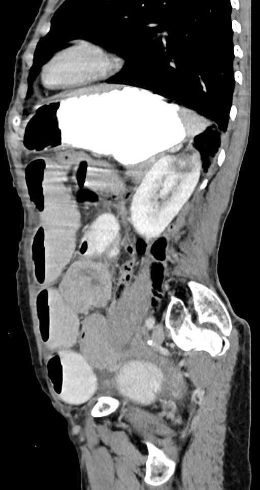 Acute small bowel (ileal) volvulus (Radiopaedia 71740-82139 Sagittal C+ portal venous phase 61).jpg