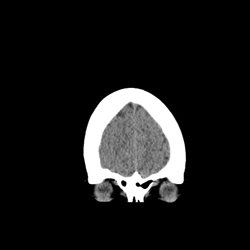 Acute subarachnoid hemorrhage and accessory anterior cerebral artery (Radiopaedia 69231-79008 Coronal non-contrast 12).jpg