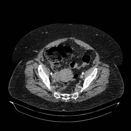 File:Acute superior mesenteric artery occlusion (Radiopaedia 51288-56960 Axial C+ arterial phase 78).jpg