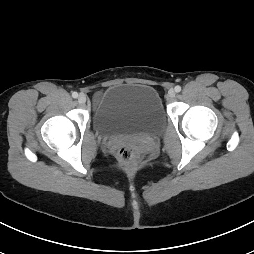 Acute uncomplicated appendicitis (Radiopaedia 61374-69304 Axial C+ portal venous phase 124).jpg