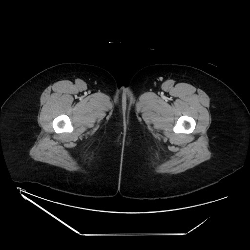 Acute uncomplicated appendicitis (Radiopaedia 73704-84499 Axial C+ portal venous phase 184).jpg