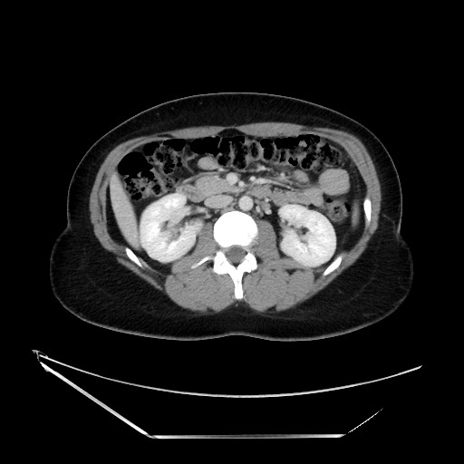 Acute uncomplicated appendicitis (Radiopaedia 73704-84499 Axial C+ portal venous phase 63).jpg