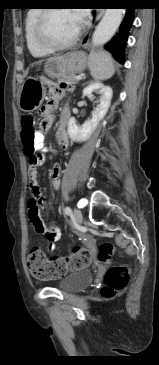 Adenocarcinoma of cecum (Radiopaedia 59222-66549 Sagittal C+ portal venous phase 30).jpg