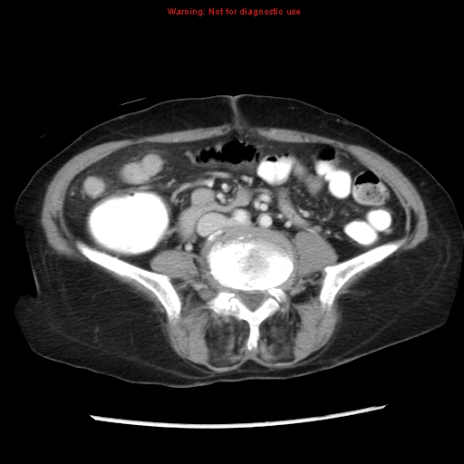 File:Adenocarcinoma of the colon (Radiopaedia 8191-9039 Axial liver window 46).jpg