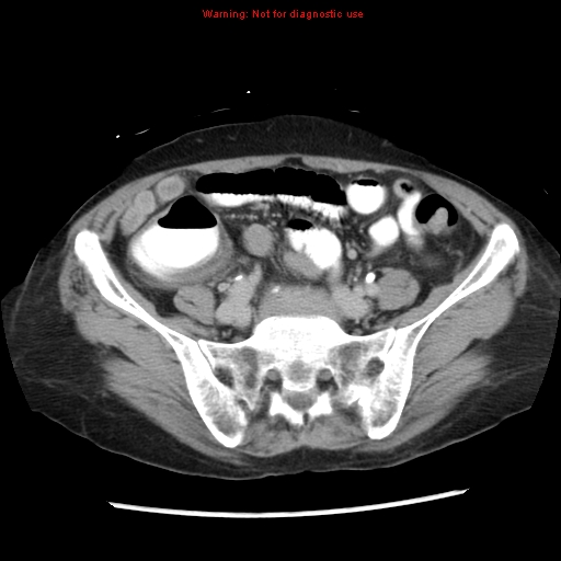 File:Adenocarcinoma of the colon (Radiopaedia 8191-9039 Axial renal excretory phase 40).jpg