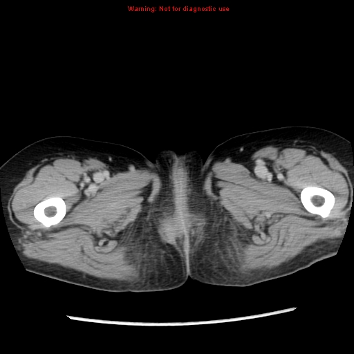 Adenocarcinoma of the colon (Radiopaedia 8191-9039 Axial renal excretory phase 70).jpg