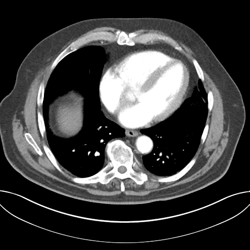 File:Adenocarcioma of rectum- T1 lesion (Radiopaedia 36921-38547 Axial C+ arterial phase 38).png