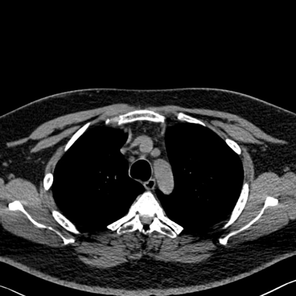 Adenoid cystic carcinoma of the trachea (Radiopaedia 49042-54137 Axial non-contrast 84).jpg