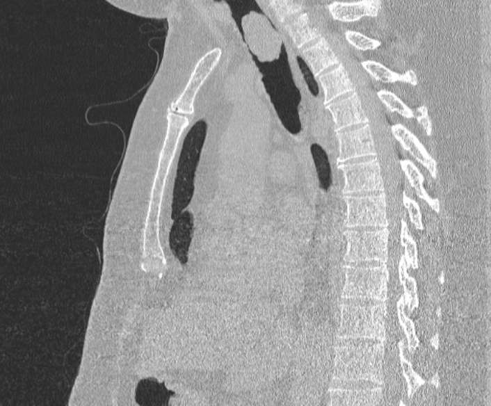 Adenoid cystic carcinoma of the trachea (Radiopaedia 49042-54137 Sagittal lung window 236).jpg