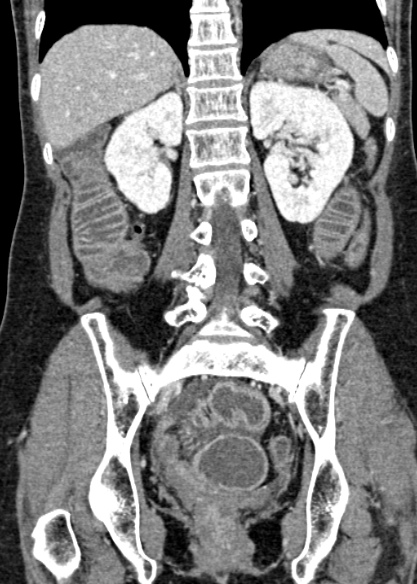Adhesional small bowel obstruction (Radiopaedia 48397-53305 Coronal C+ portal venous phase 235).jpg