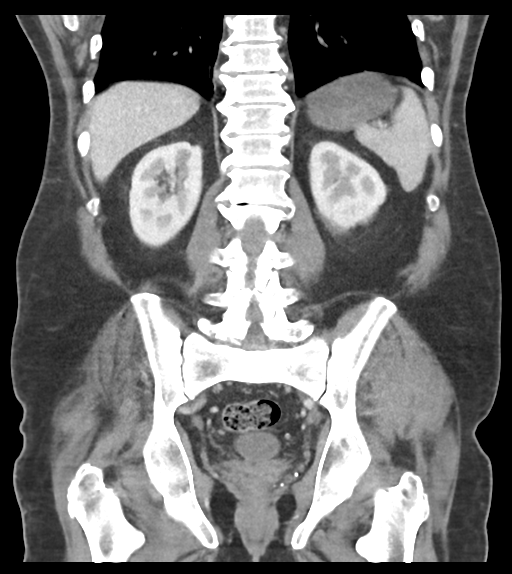 Adhesions within abdominal wall hernia (Radiopaedia 58283-65394 Coronal C+ portal venous phase 50).png