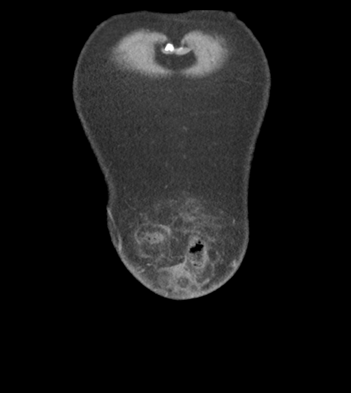 Adhesions within abdominal wall hernia (Radiopaedia 58283-65394 Coronal C+ portal venous phase 7).png