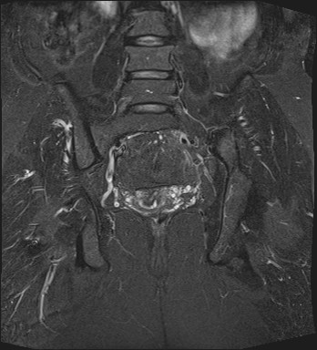 File:Adnexal multilocular cyst (O-RADS US 3- O-RADS MRI 3) (Radiopaedia 87426-103754 Coronal T2 fat sat 22).jpg