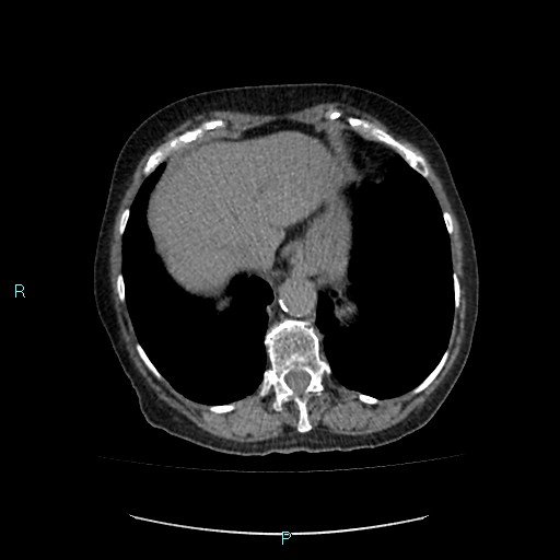 File:Adrenal collision tumor (ACT) (Radiopaedia 48462-53379 Axial non-contrast 8).jpg