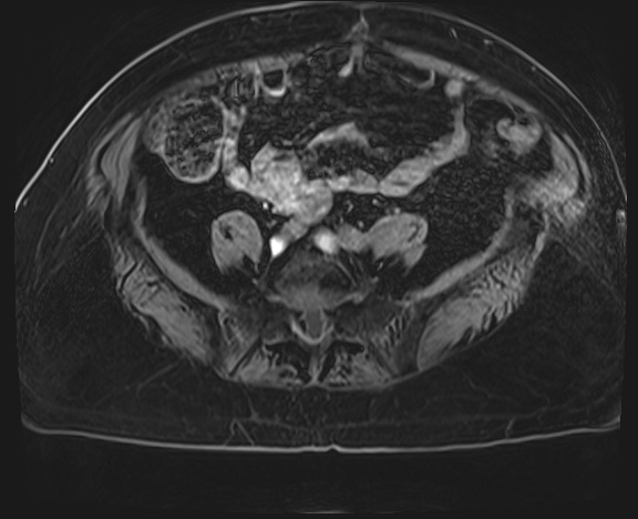 Adrenal cortical carcinoma (Radiopaedia 64017-72770 H 65).jpg