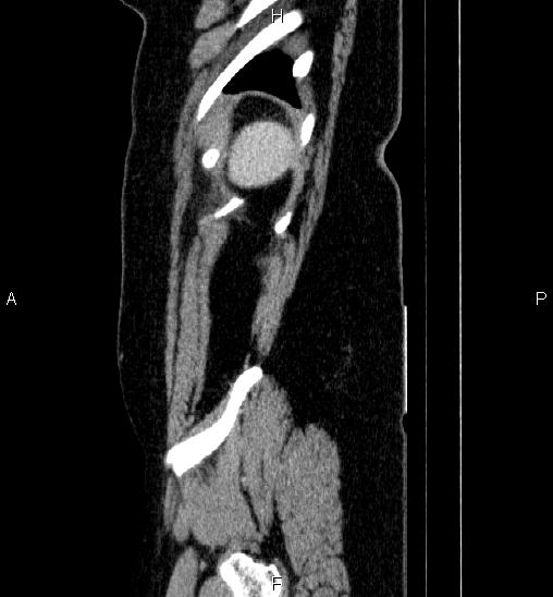 Adrenal cortical carcinoma (Radiopaedia 84882-100379 Sagittal C+ portal venous phase 81).jpg