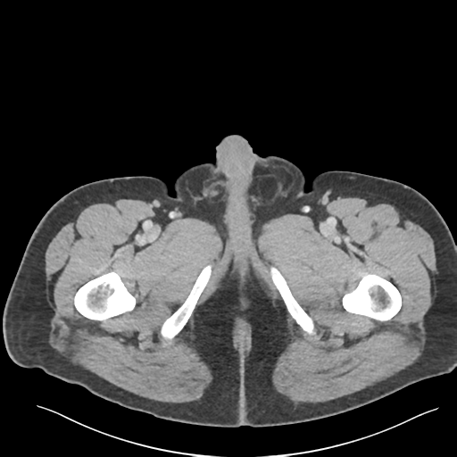 Adrenal cyst (Radiopaedia 45625-49777 Axial C+ portal venous phase 111).png