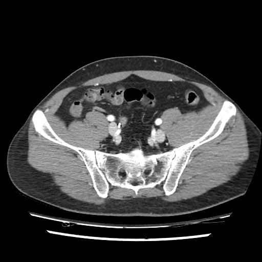Adrenal gland trauma (Radiopaedia 81351-95078 Axial Dual bolus trauma C+ 102).jpg