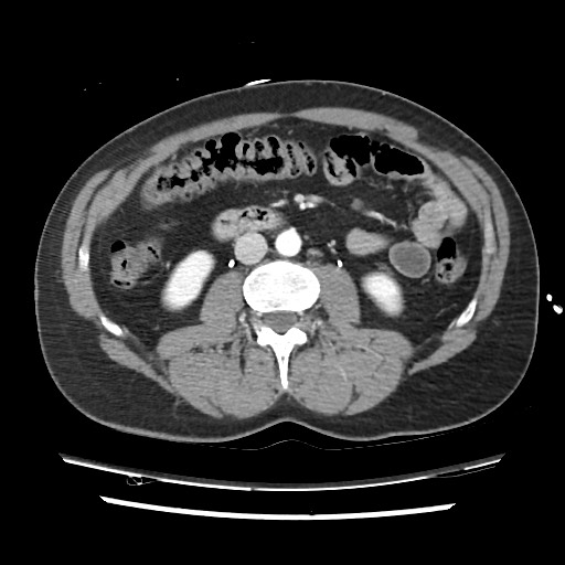 File:Adrenal gland trauma (Radiopaedia 81351-95078 Axial Dual bolus trauma C+ 79).jpg