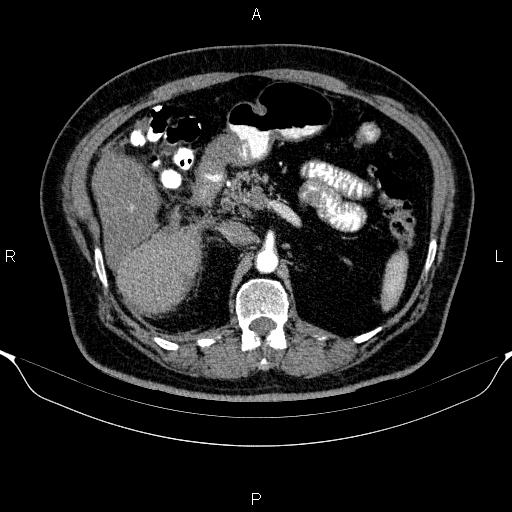 Adrenal hemorrhage (Radiopaedia 62622-70916 Axial C+ arterial phase 136).jpg