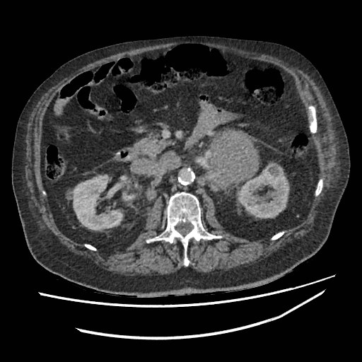 Adrenal lymphoma (Radiopaedia 84145-99415 Axial C+ portal venous phase 53).jpg