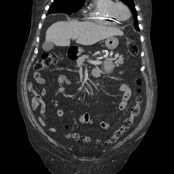 Adrenal lymphoma (Radiopaedia 84145-99415 Coronal C+ portal venous phase 27).jpg