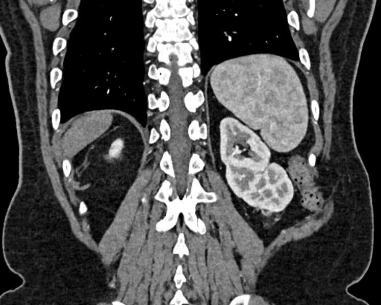 Adrenal metastases (Radiopaedia 73082-83791 Coronal C+ arterial phase 67).jpg