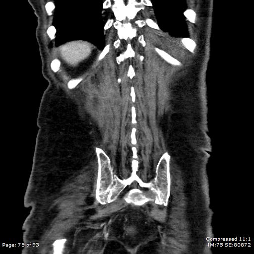 Adrenal metastasis (Radiopaedia 78425-91079 Sagittal C+ portal venous phase 62).jpg