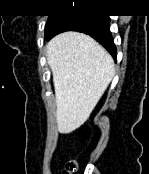 Adrenal myelolipoma (Radiopaedia 82742-96986 Sagittal renal cortical phase 20).jpg