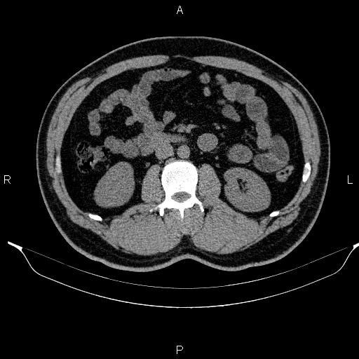 Adrenal myelolipoma (Radiopaedia 84321-99619 Axial non-contrast 53).jpg