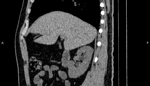 Adrenal myelolipoma (Radiopaedia 84321-99619 Sagittal non-contrast 34).jpg