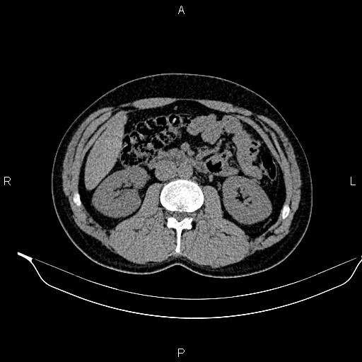 File:Adrenal myelolipoma (Radiopaedia 87794-104246 Axial non-contrast 49).jpg