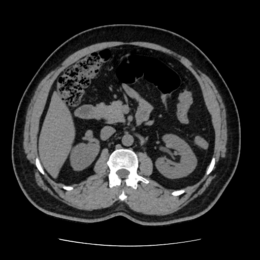 Adrenal myelolipoma and beaver tail liver (Radiopaedia 86201-102193 Axial non-contrast 191).jpg