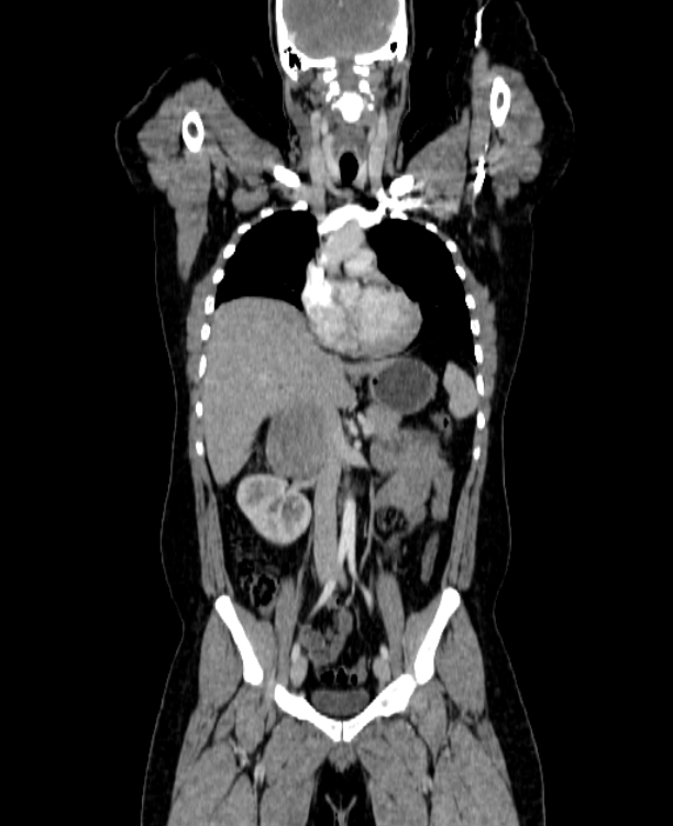 Adrenocortical carcinoma (Radiopaedia 80134-93438 Coronal C+ portal venous phase 78).jpg