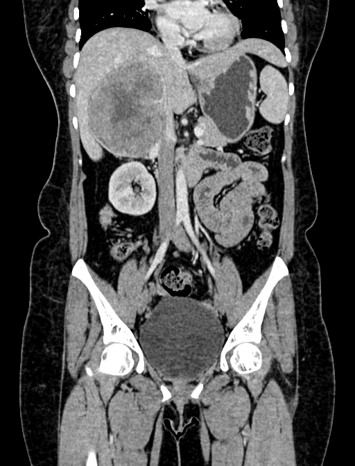 Adrenocortical carcinoma (Radiopaedia 87281-103569 Coronal C+ portal venous phase 39).jpg