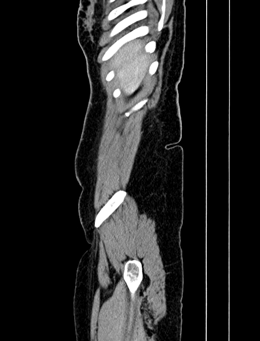 Adrenocortical carcinoma (Radiopaedia 87281-103569 Sagittal C+ portal venous phase 3).jpg