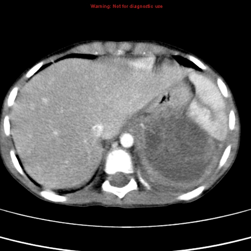 File:Adrenocortical carcinoma (Radiopaedia 9449-10131 Axial C+ portal venous phase 8).jpg