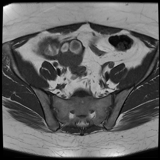 File:Adult granulosa cell tumor of the ovary (Radiopaedia 64991-73953 Axial T1 9).jpg