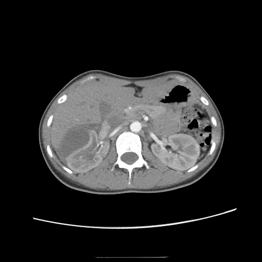 Adult polycystic kidney disease (Radiopaedia 48845-53876 Axial renal cortical phase 19).jpg