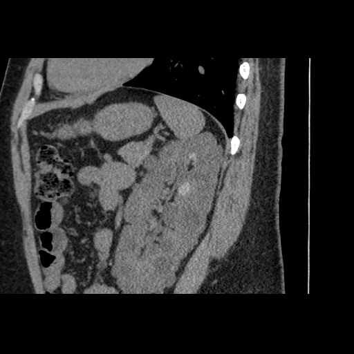 Adult polycystic kidney disease (Radiopaedia 59075-66368 Sagittal non-contrast 66).jpg