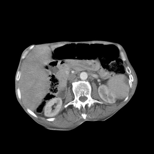 Aggressive lung cancer with cardiac metastases, pulmonary artery tumor thrombus, and Budd-Chiari (Radiopaedia 60320-67981 A 64).jpg