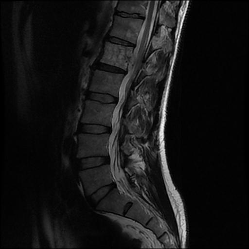 File:Aggressive vertebral hemangioma with pathological fracture (Radiopaedia 69528-79411 Sagittal T2 6).jpg