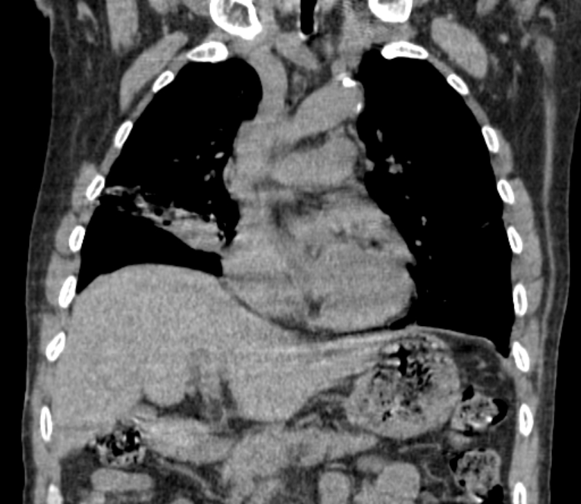 Airway foreign body in adult (Radiopaedia 85907-101779 Coronal liver window 110).jpg