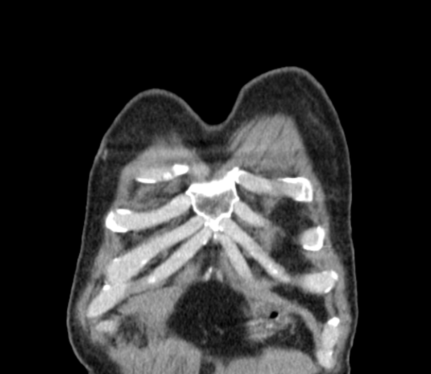 Airway foreign body in adult (Radiopaedia 85907-101779 Coronal liver window 6).jpg
