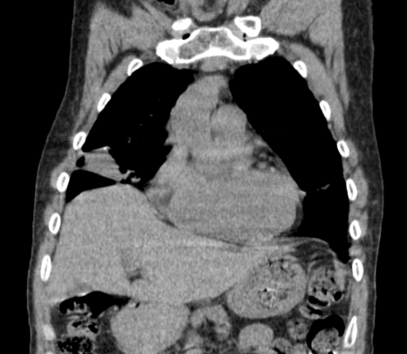 Airway foreign body in adult (Radiopaedia 85907-101779 Coronal liver window 72).jpg