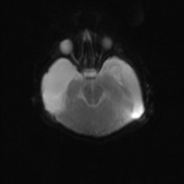 Alobar holoprosencephaly (Radiopaedia 52472-58384 Axial DWI and ADC 5).jpg