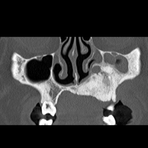File:Ameloblastic fibro-odontoma (Radiopaedia 18843-18780 B 11).jpg