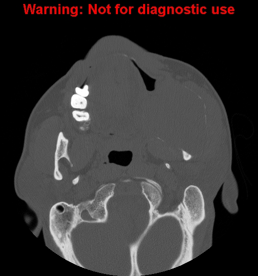 File:Ameloblastoma (Radiopaedia 13276-13280 Axial non-contrast 15).jpg