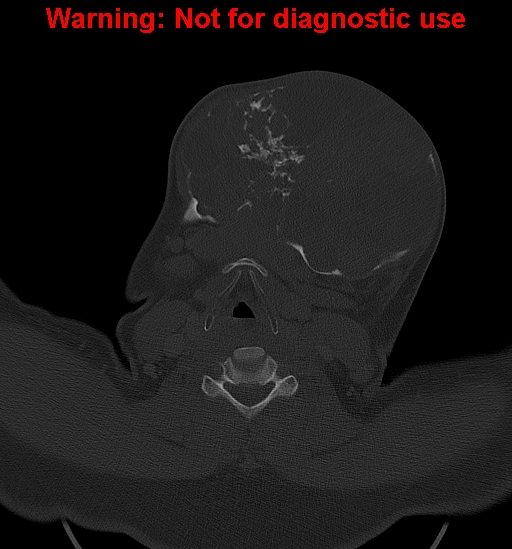 Ameloblastoma (Radiopaedia 33126-34164 Axial bone window 25).jpg